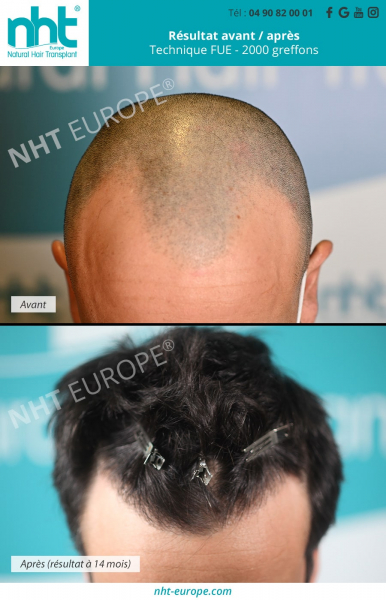 greffe-capillaire-2000-greffons-densification-sommet-du-crane-et-ligne-frontale-resultats-avant-apres-post-operatoire-14-mois-cheveux-longs-repousse-nht-avigon