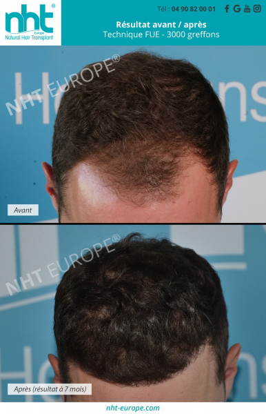 greffe-de-cheveux-3000-greffons-technique-fue-dhi-hair-transplant-ligne-frontale-naturelle-image-avant-apres-7-mois
