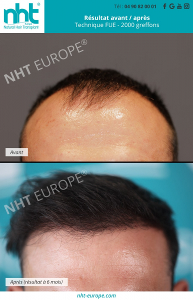 Greffe de cheveux 2000 greffons resultat avant apres technique fue implant capillaire centre de greffe avignon alopecie sud de la France perte de cheveux