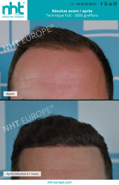 greffe-de-cheveux-3000-greffons-technique-fue-dhi-hair-transplant-ligne-frontale-naturelle-image-avant-apres