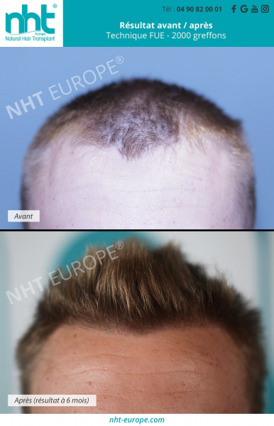 Greffe-capillaire-homme-resultat-avant-apres-6-mois-post-operatoire-ligne-frontale-technique-fue-2000-greffons-densité-calvitie-perte-de-cheveux-solution-avignon-vaucluse