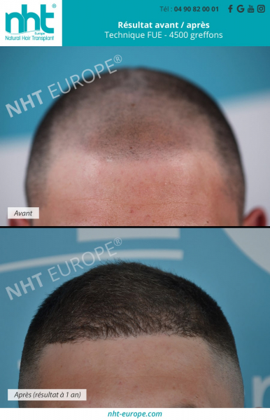 greffe-de-cheveux-sur-cicatrice-et-micropigmentation-4500-greffons-technique-fue-dhi-resultat-1-an-clinique-nht-france-avignon