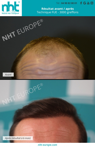 greffe-capillaire-sur-homme-cheveux-chatains-resultat-avant-apres-6-mois-avant-apres-3000-greffons-nht-europe-technique-fue