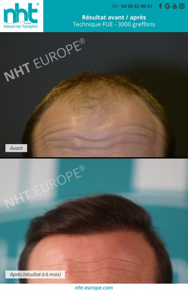 greffe capillaire homme cheveux chatains resultat avant apres 6 mois avant apres 3000 greffons nht europe technique fue