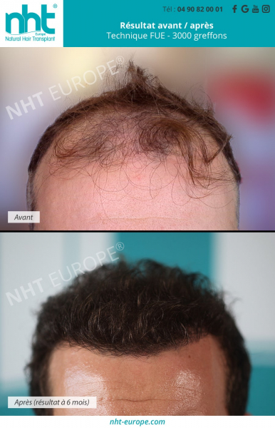 Greffe-de-cheveux-zone-frontale-avant-du-crane-sommet-du-crane-implant-capillaire-alopecie-chute-de-cheveux-calvitie-homme-solution-repousse-resultat-6-mois-post-operatoire-vaucluse