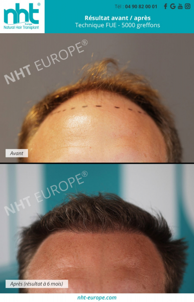 Greffe-capillaire-homme-resultat-avant-apres-6-mois-post-operatoire-ligne-frontale-technique-fue-5000-greffons-densité-calvitie-perte-de-cheveux-solution-avignon-vaucluse