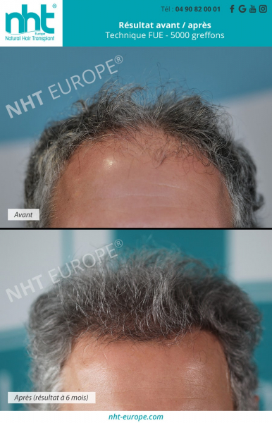 Implant-capillaire-5000-greffons-technique-fue-resultat-avant-apres-densification-golfes-fronto-temporaux-ligne-frontale-vertex-sommet-du-crane-nht-europe-avignon-cheveux-blancs-gris