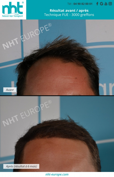 greffe de cheveux jeune homme 3000 greffons resultat avant apres calvitie solution