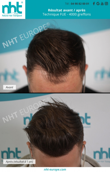 greffe de cheveux ligne frontale 4000 greffons resultat avant apres france