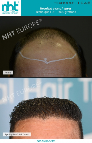 greffe-de-cheveux-resultat-avant-apres-technique-fue-3000-greffons-a-2-ans-ligne-frontale-avant-du-crane-recul-des-cheveux-homme-brun-avignon-clinique-capillaire-nht-europe