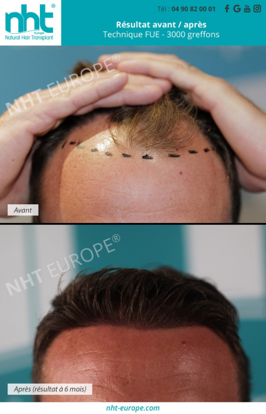 ligne frontale apres une greffe de cheveux de 3000 greffons technique fue resultat avant apres 6 mois de repousses perte de cheveux calvitie homme creusement des golfes sur les cotés cheveux qui tombent meilleure clinique nht traitement chute de cheveux