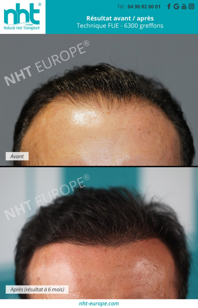 greffe-de-cheveux-resultat-avant-apres-a-6-mois-6300-greffons-cheveux-homme-brun-technique-fue-zone-linge-frontale-densification-epaisseur-cheveux-epais-clinique-nht-sud-de-la-france-centre-capillaire-excellent