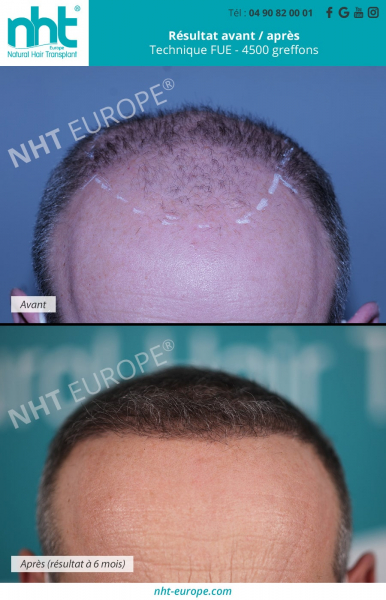 greffe-de-cheveux-resultat-avant-apres-technique-fue-4500-greffons-a-6-mois-ligne-frontale-avant-du-crane-recul-des-cheveux-homme-brun-avignon-clinique-capillaire-nht-europe