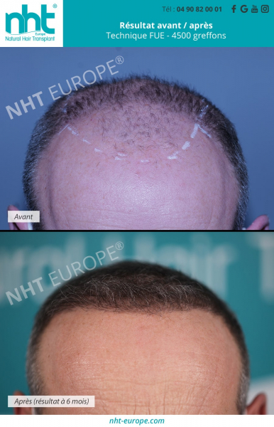 greffe de cheveux resultat avant apres technique fue 4500 greffons a 6 mois ligne frontale avant du crane recul des cheveux homme brun avignon clinique capillaire nht europe