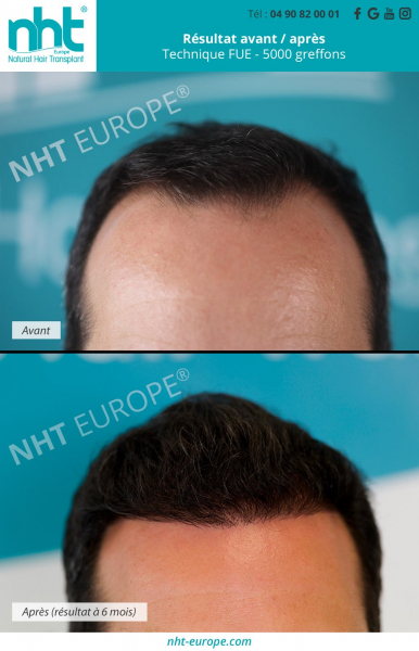 greffe-de-cheveux-transplantation-capillaire-resultat-avant-apres-6-miis-5000-greffons-mega-session-technique-fue-dhi-zone-donneuse-ligne-frontale-fronto-temporale-front-avant-du-crane-de-la-tete-clinique-nht-cheveux-homme-perte-dechevux-chute-calvitie-al