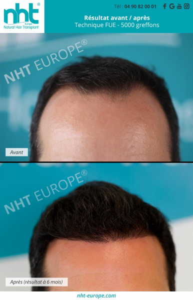greffe de cheveux transplantation capillaire resultat avant apres 6 mois 5000 greffons mega session technique fue dhi zone donneuse ligne frontale fronto temporale clinique nht cheveux homme perte de cheveux chute calvitie