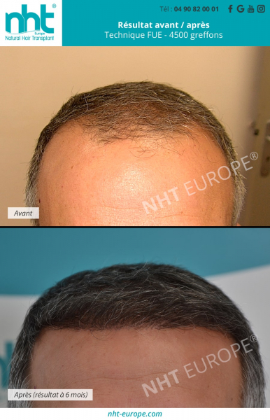 transplantation-capillaire-cheveux-4500-greffons-ensemble-du-crane-et-ligne-frontale-à-6-mois-pousse-des-cheveux-cheveux-plus-epais-clinique-centre-de-greffe-capillaire-sud-de-la-france