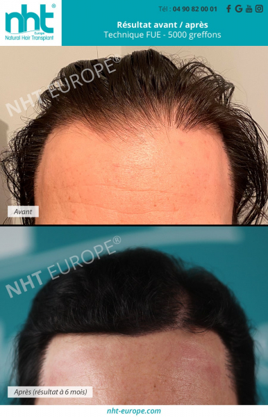 greffe capillaire homme brun technique fue 5000 greffons resultat avant apres 6 mois post operatoire densification ligne frontale golfes fronto temporaux sommet du crane calvitie solution perte de cheveux alopecie pelade clinique centre nht avignon