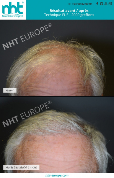 greffe de cheveux capillaire sur homme agé cheveux blancs 8 mois post opératoire repousse des cheveux ligne frontale