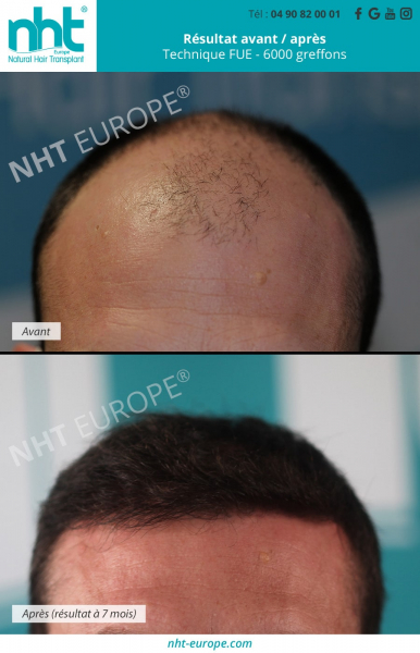 greffe-de-cheveux-homme-resultat-avant-apres-6000-greffons-7-mois-post-operatoire-golfes-fronto-temporaux-ligne-frontale-front-crane-repousses-des-cheveux-stopper-la-calvitie-alopecie-vieillissement-cheveux-bruns-centre-clinique-nht-europe-sud-de-la-franc