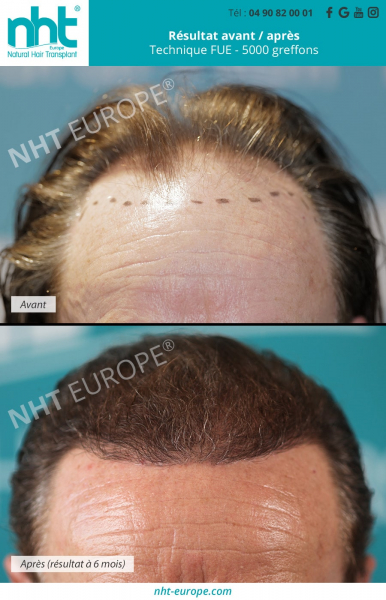 greffe implant capillaire fue dhi homme agé 5000 greffons resultat avant apres 6 mois photo ligne frontale zone frontale sommet du crane clinique nht europe paris lyon toulon cannes nice marseille avignon