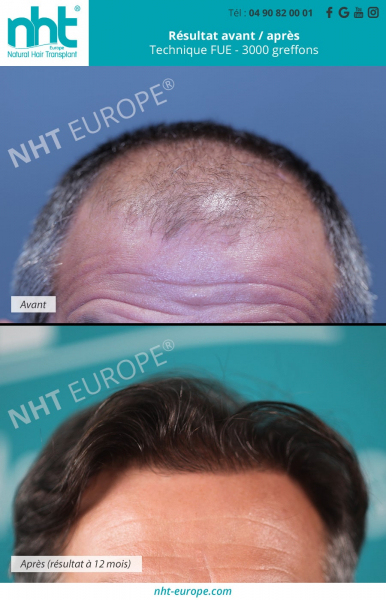 greffe-de-cheveux-implant-capillaire-homme-technique-fue-dhi-3000-greffons-resultat-avant-apres-12-mois-repousse-des-cheveux-lutter-stopper-la-calvitie-perte-chute-de-cheveux-complexe-alopecie-zone-frontale-sommet-du-crane-densité-minoxidil-finasteride-tr
