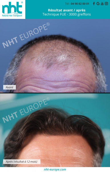 greffe de cheveux implant capillaire homme technique fue dhi 3000 greffons resultat avant apres 12 mois repousse des cheveux lutter stopper la calvitie perte chute de cheveux complexe alopecie zone frontale sommet du crane densité minoxidil finasteride