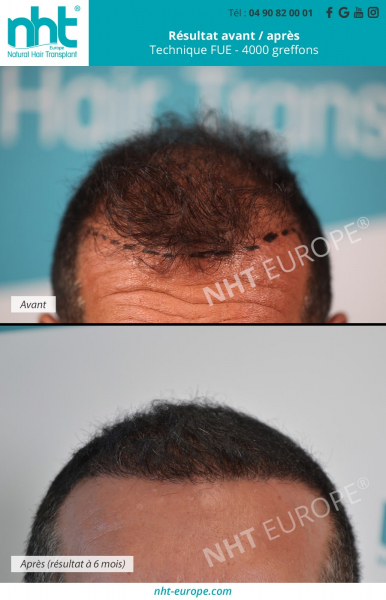 4000-greffons-greffe-de-cheveux-technique-dhi-fue-paris-resultat-avant-pousse-des-cheveux-homme-densification-longueur-ligne-frontale-clinique-de-greffe-immplant-capillaire-avignon-photos