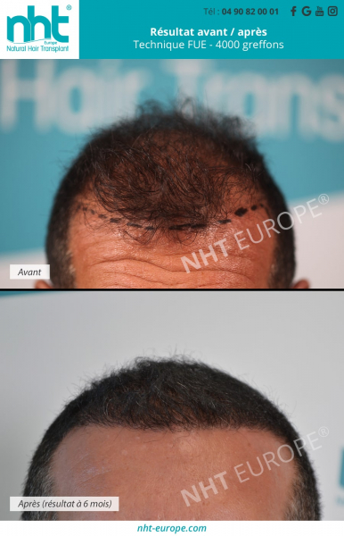 4000 greffons greffe de cheveux technique dhi fue paris resultat avant pousse des cheveux homme densification longueur ligne frontale clinique de greffe implant capillaire avignon photos
