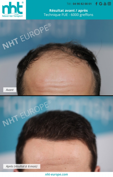 implant-capillaire-greffe-de-cheveux-france-6000-greffons-technique-fue-dhi-resultat-avant-apres-6-mois-post-operatoire-ligne-frontale-golfes-fronto-temporaux-cheveux-épais-calvitie-solution-alopecie-clinique-sud-de-la-france-avignon-marseille-montpellier