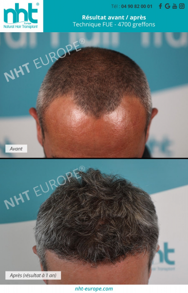 greffe de cheveux fue technique dhi 4700 greffons ligne frontale golfes temporaux