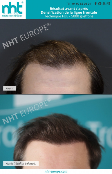 implants capillaires greffe de cheveux sur jeune homme resultat avant apres technique fue dhi 5000 greffons centre nht avignon