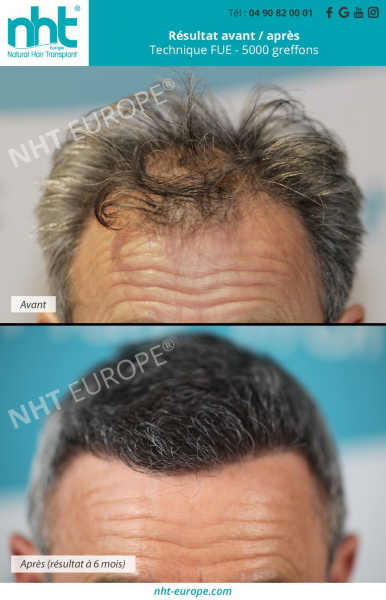 resultat avant apres greffe de cheveux implant capillaire homme 59 ans technique fue dhi 5000 greffons repousse calvitie alopecie ligne frontale golfes fronto temporaux meilleure clinique france