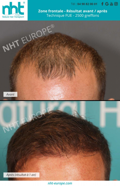 greffe de cheveux methode fue 3500 greffons resultat avant apres 1 an