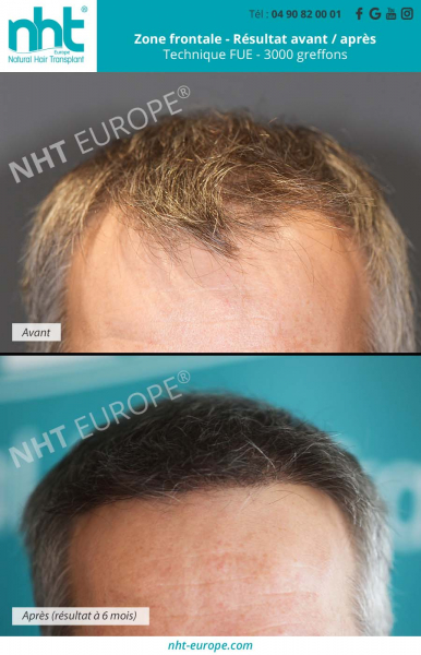 greffe de cheveux resultat avant apres 3000 greffons a 6 mois