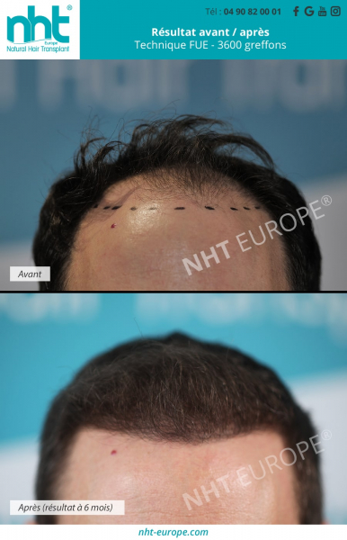 photo avant/après du résultat d'une greffe capillaire après 6 mois post opératoire avec 3600 greffons implantés technique fue dhi sans cicatrices et indolore