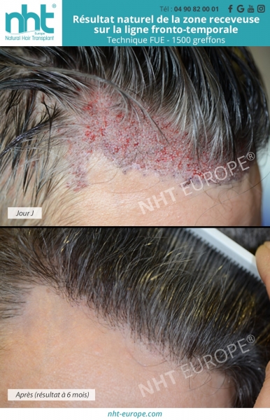 resultat a 6 mois de la ligne fronto temporale implants capillaires technique fue