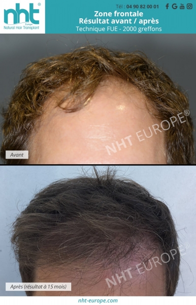 implant capillaire avec la technique fue de 2000 greffons