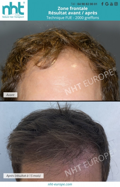 implant-capillaire-avec-la-technique-fue-de-2000-greffons