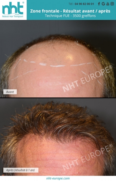greffe de cheveux homme alopecie sur la zone frontale 3500 greffons