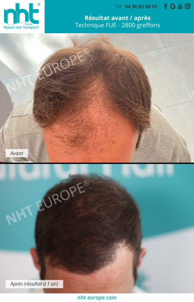 resultat-1-an-apres-greffe-de-cheveux-implant-capillaire-2800-greffons-methode-fue-calvitie-alopecie-homme