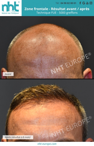ligne frontale apres une greffe de cheveux de 5000 greffons avec la methode fue