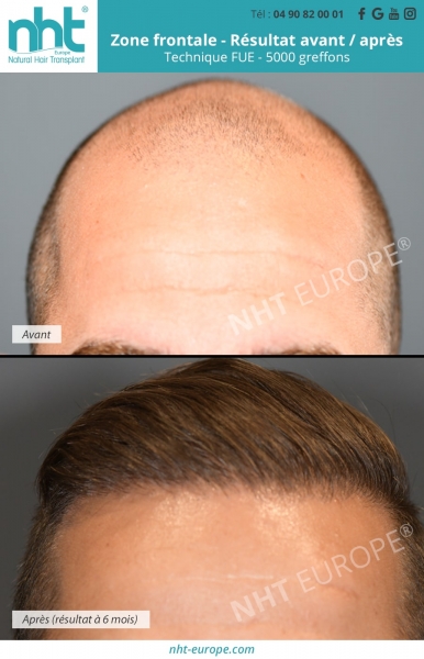 calvitie sur la zone frontale comblage avec implant capillaire 5000 greffons repousse des cheveux a 6 mois