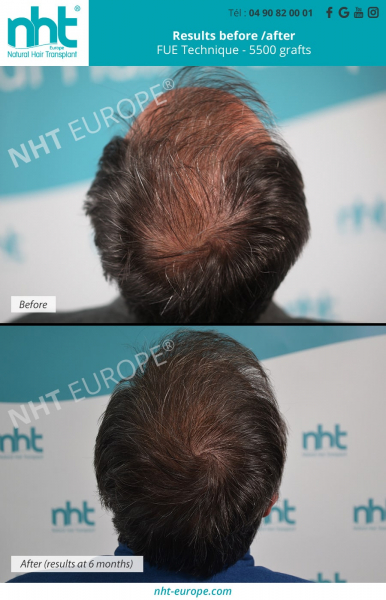 before-after-results-5500-grafts-hair-transplant-fue-dhi-technique-vertex-area-hair-loss-solution-treatment