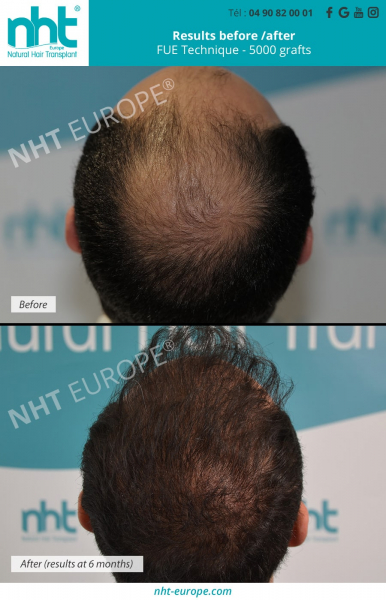 vertex-hair-transplant-5000-grafts-before-after-results-at-6-months