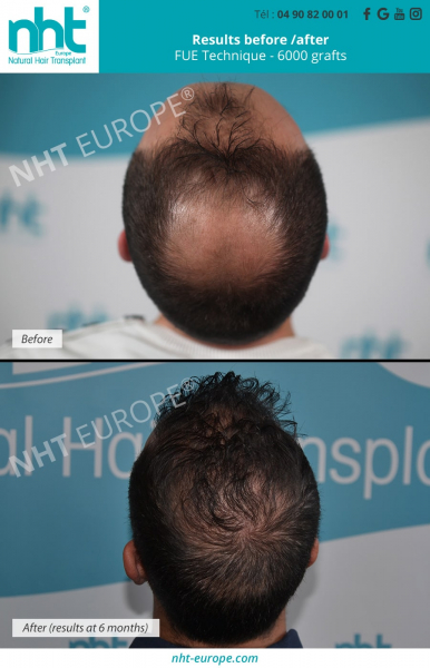 6000 grafts hairtransplant vertex top of the head and hairline