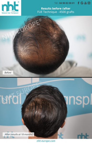 vertex hairtransplant with 4500 grafts man