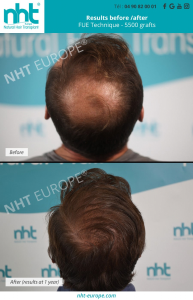 vertex-area-5500-grafts-hair-transplant-fue-dhi-technique-hair-loss-baldness-solution-