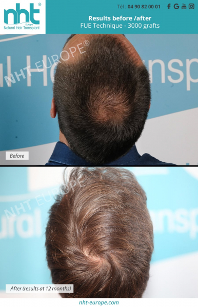 vertex tonsur hairtransplant baldness solution before after results