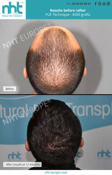 whole scalp hair transplant 4500 grafts nht europe
